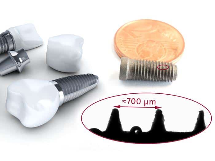 Surface Energy Analysis of Dental Implants after Plasma Activation: The droplet between the screw threads of a dental implant