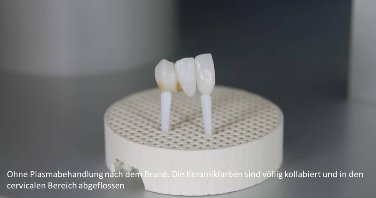 Trial bridge without prior plasma treatment. After firing, the ceramic shades collapsed and flowed off into the cervical area.